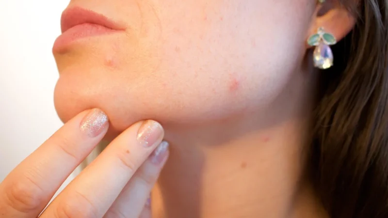 Benzacne 10% żel 30g